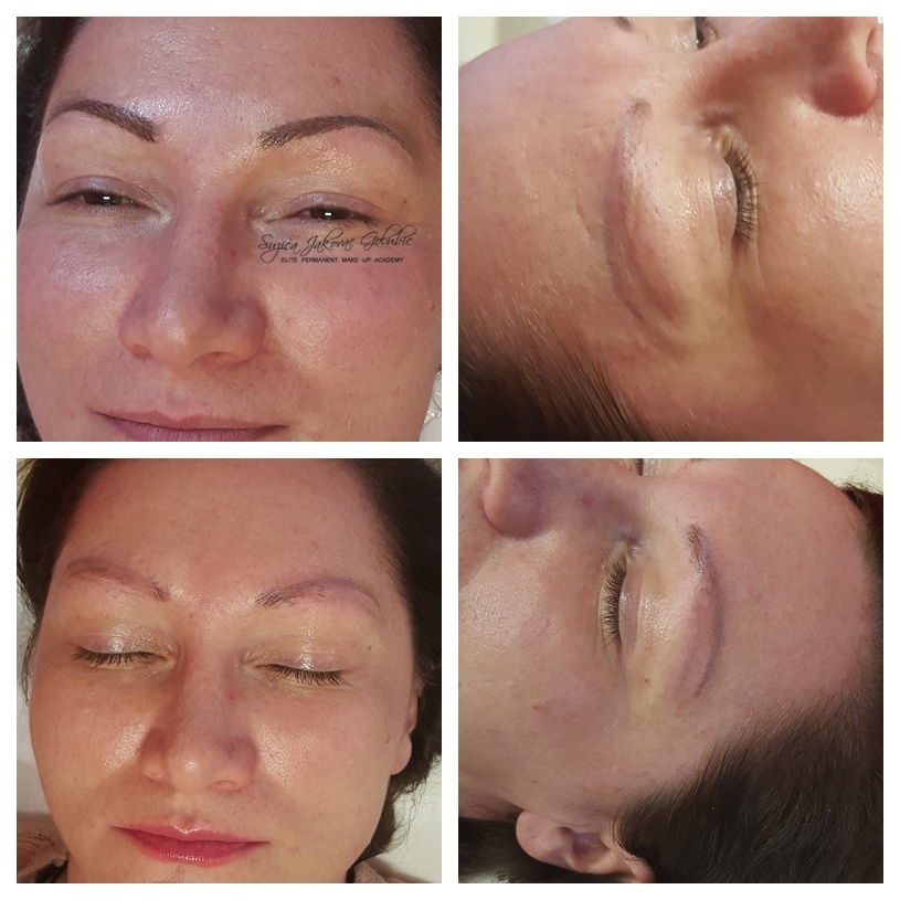Non Laser Pigment Removal i nove obrve - jedan dolazak