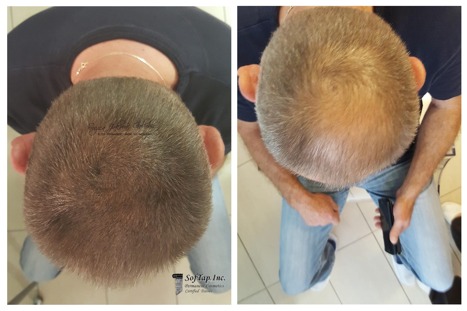Kosa-scalp